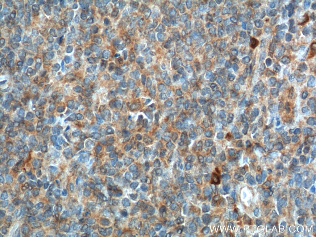 Immunohistochemistry (IHC) staining of human tonsillitis tissue using CD226 Polyclonal antibody (17842-1-AP)