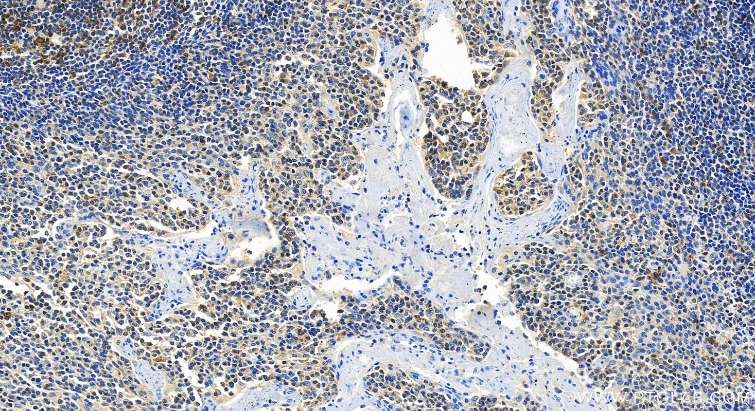 Immunohistochemistry (IHC) staining of human tonsillitis tissue using CD226 Recombinant antibody (82991-3-RR)