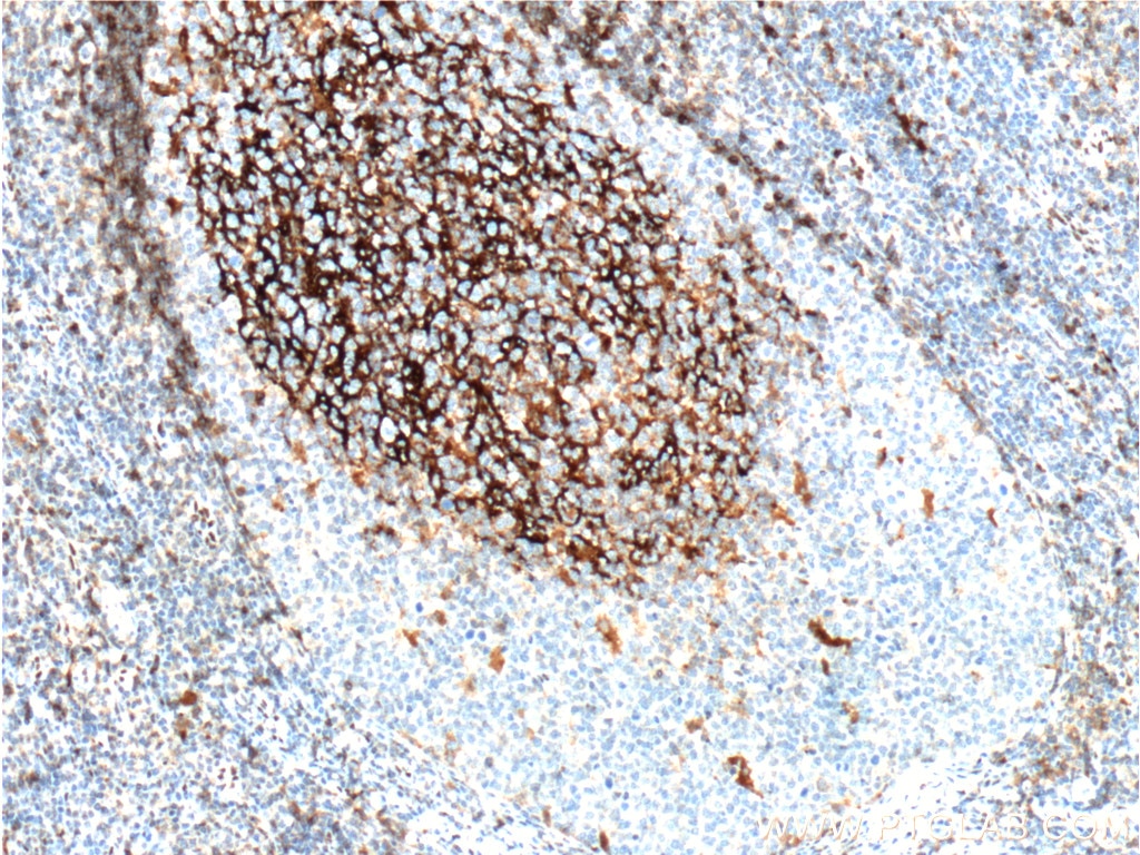 Immunohistochemistry (IHC) staining of human tonsillitis tissue using CD23 Polyclonal antibody (10300-1-AP)