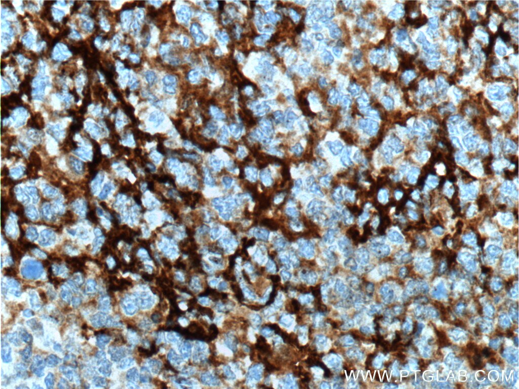 Immunohistochemistry (IHC) staining of human tonsillitis tissue using CD23 Polyclonal antibody (10300-1-AP)