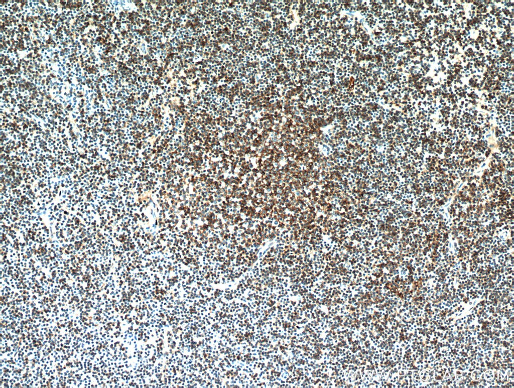 Immunohistochemistry (IHC) staining of human lymphoma tissue using CD23 Polyclonal antibody (10300-1-AP)
