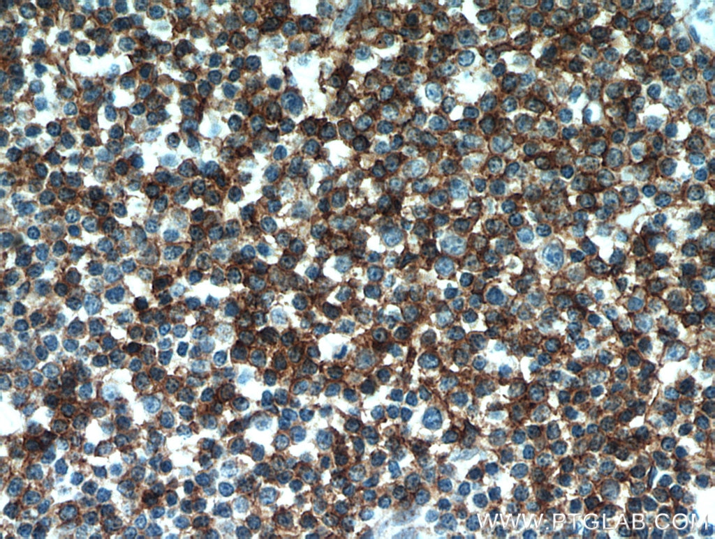 Immunohistochemistry (IHC) staining of human lymphoma tissue using CD23 Polyclonal antibody (10300-1-AP)