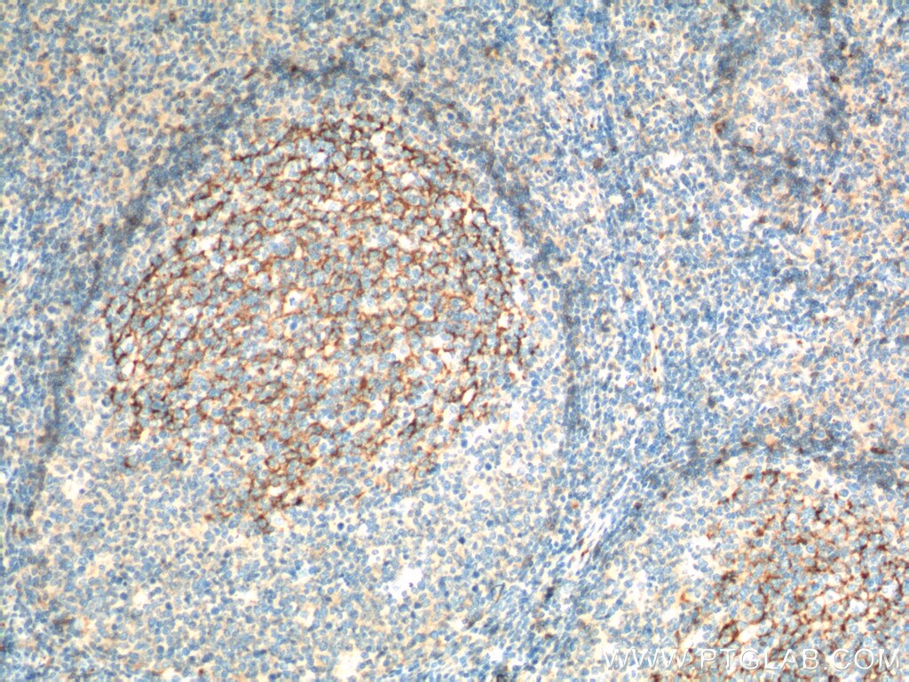 Immunohistochemistry (IHC) staining of human tonsillitis tissue using CD23 Monoclonal antibody (60208-1-Ig)