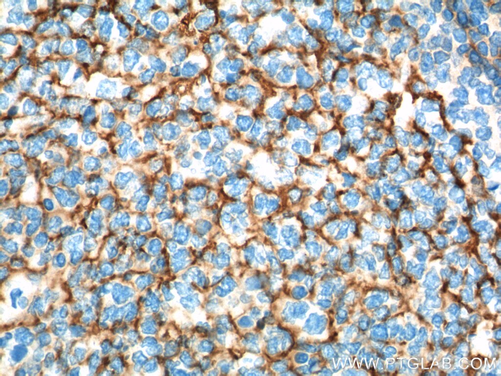 Immunohistochemistry (IHC) staining of human tonsillitis tissue using CD23 Monoclonal antibody (60208-1-Ig)