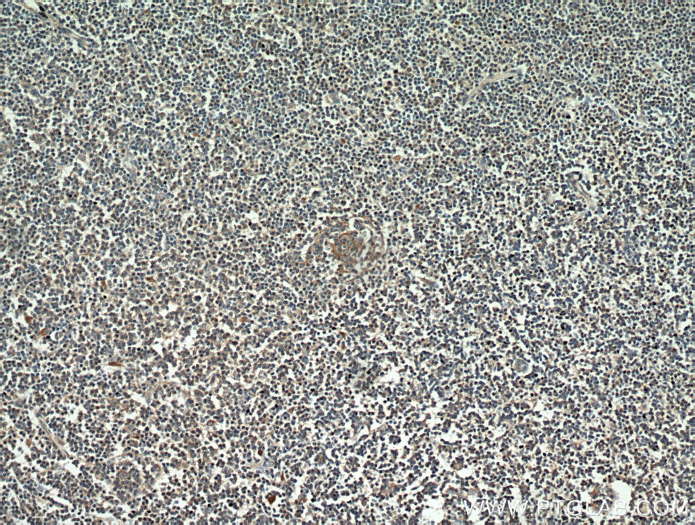 Immunohistochemistry (IHC) staining of human lymphoma tissue using CD23 Monoclonal antibody (60208-1-Ig)