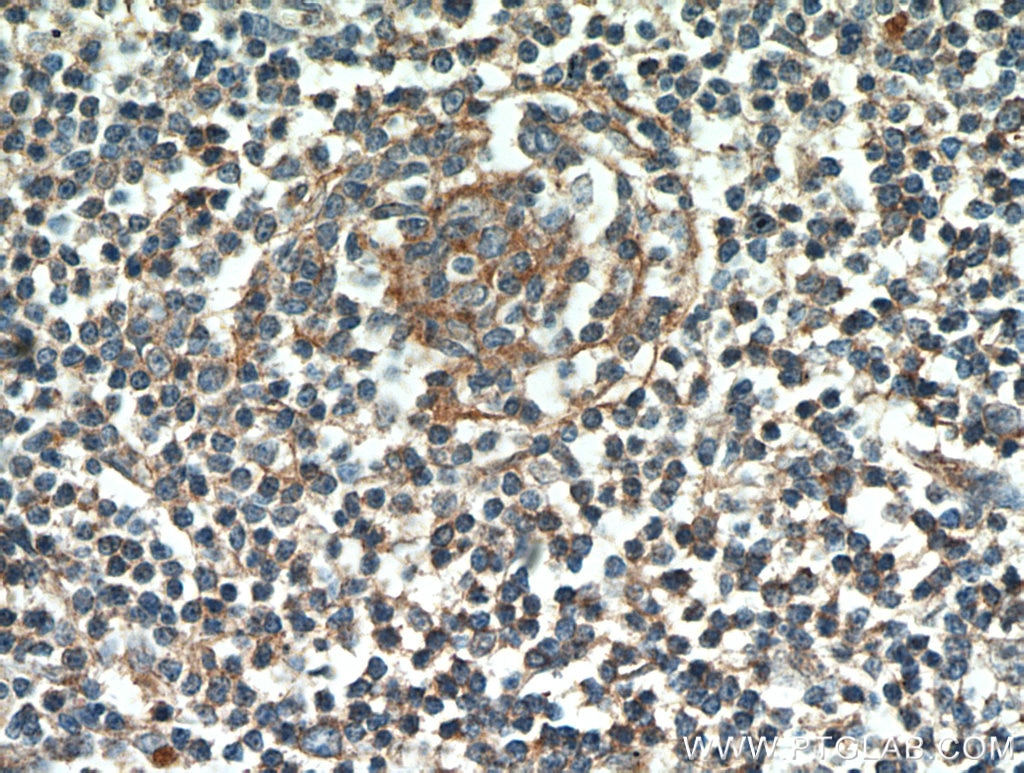 Immunohistochemistry (IHC) staining of human lymphoma tissue using CD23 Monoclonal antibody (60208-1-Ig)