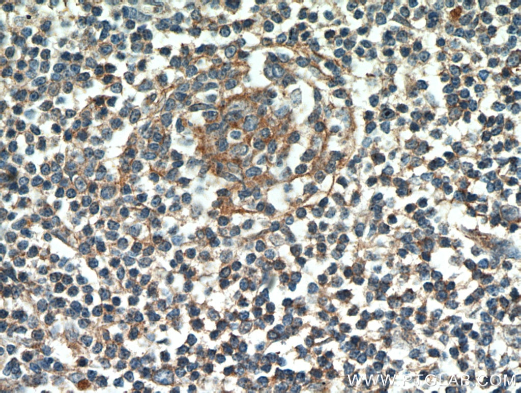 IHC staining of human lymphoma using 60208-1-Ig