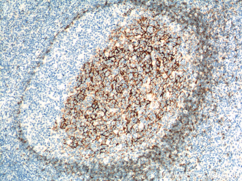 Immunohistochemistry (IHC) staining of human tonsillitis tissue using CD23 Monoclonal antibody (60208-2-Ig)