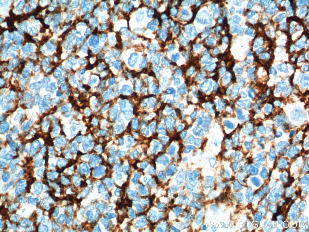 Immunohistochemistry (IHC) staining of human tonsillitis tissue using CD23 Monoclonal antibody (60208-2-Ig)