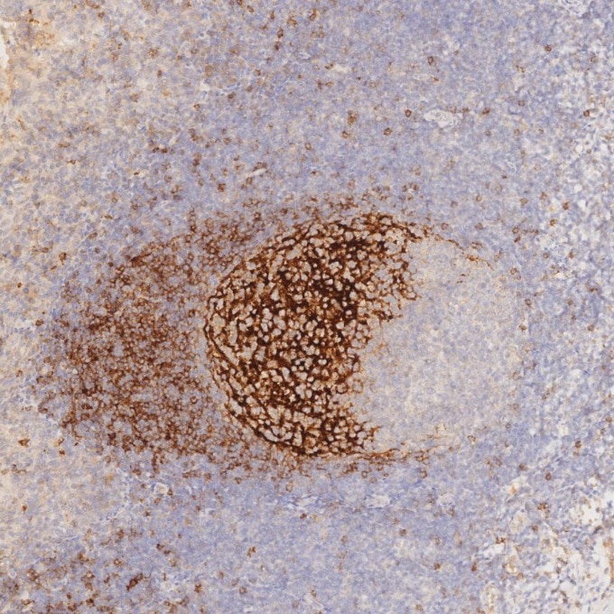 IHC staining of human tonsillitis using 60208-2-Ig Immunohistochemistry (IHC) staining of human tonsillitis tissue using CD23 Monoclonal antibody (60208-2-Ig)