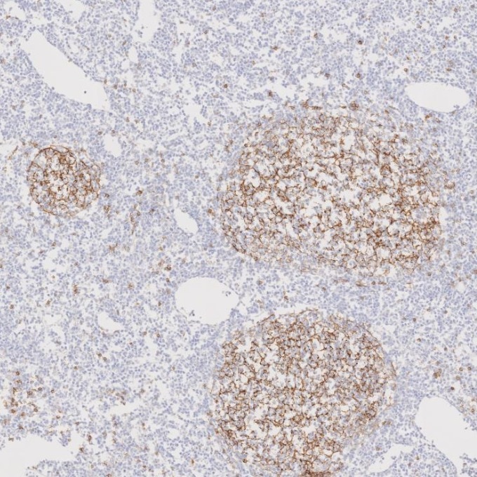 IHC staining of human lymphoma using 60208-2-Ig Immunohistochemistry (IHC) staining of human lymphoma tissue using CD23 Monoclonal antibody (60208-2-Ig)