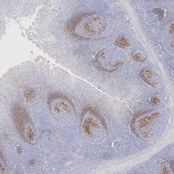 IHC staining of human tonsillitis using 60208-2-Ig Immunohistochemistry (IHC) staining of human tonsillitis tissue using CD23 Monoclonal antibody (60208-2-Ig)