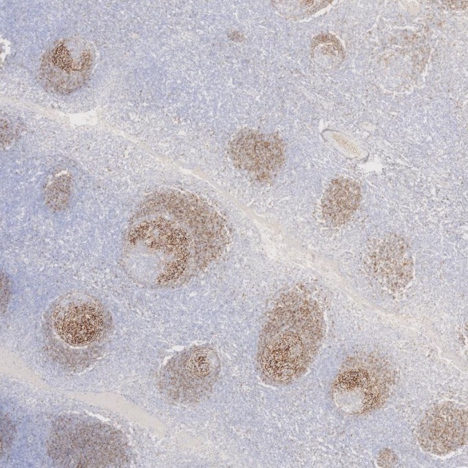 IHC staining of human tonsillitis using 60208-2-Ig Immunohistochemistry (IHC) staining of human tonsillitis tissue using CD23 Monoclonal antibody (60208-2-Ig)