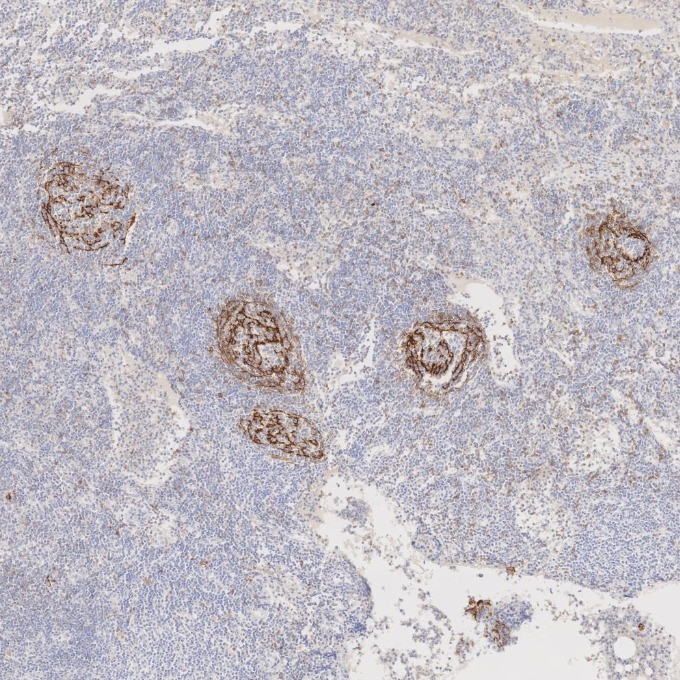 IHC staining of human lymphoma using 60208-2-Ig Immunohistochemistry (IHC) staining of human lymphoma tissue using CD23 Monoclonal antibody (60208-2-Ig)