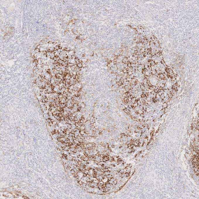 IHC staining of human lymphoma using 60208-2-Ig Immunohistochemistry (IHC) staining of human lymphoma tissue using CD23 Monoclonal antibody (60208-2-Ig)