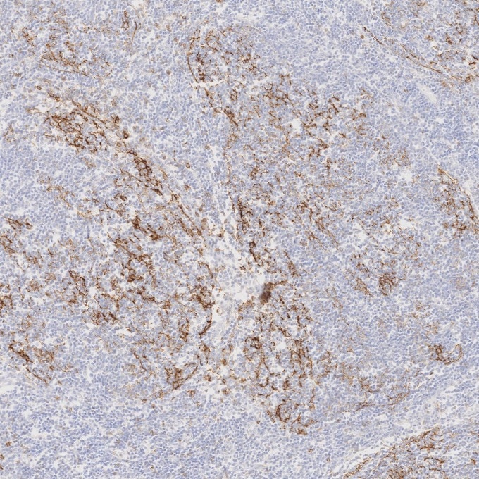 IHC staining of human lymphoma using 60208-2-Ig Immunohistochemistry (IHC) staining of human lymphoma tissue using CD23 Monoclonal antibody (60208-2-Ig)