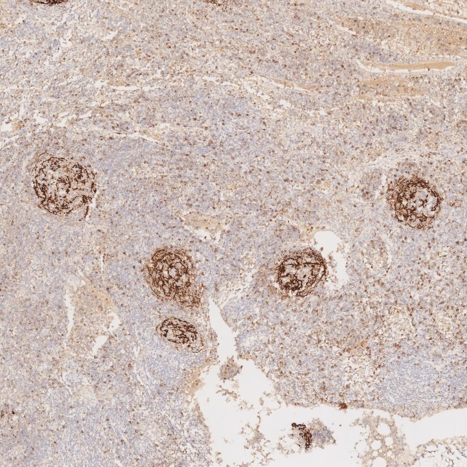 IHC staining of human lymphoma using 60208-2-Ig Immunohistochemistry (IHC) staining of human lymphoma tissue using CD23 Monoclonal antibody (60208-2-Ig)