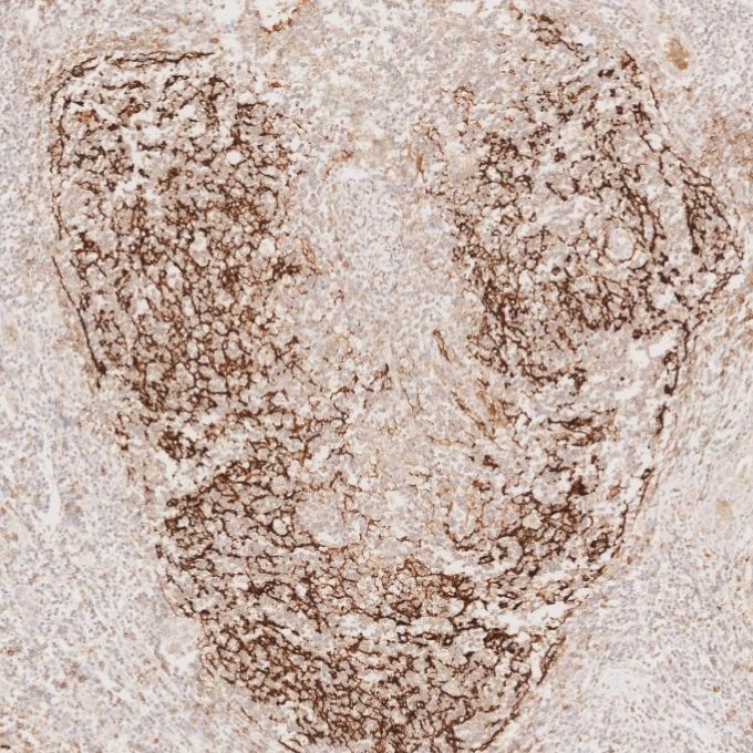 IHC staining of human lymphoma using 60208-2-Ig Immunohistochemistry (IHC) staining of human lymphoma tissue using CD23 Monoclonal antibody (60208-2-Ig)