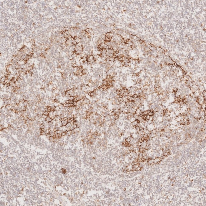 IHC staining of human lymphoma using 60208-2-Ig Immunohistochemistry (IHC) staining of human lymphoma tissue using CD23 Monoclonal antibody (60208-2-Ig)
