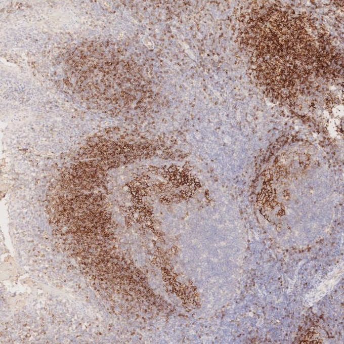 IHC staining of human tonsillitis using 60208-2-Ig Immunohistochemistry (IHC) staining of human tonsillitis tissue using CD23 Monoclonal antibody (60208-2-Ig)