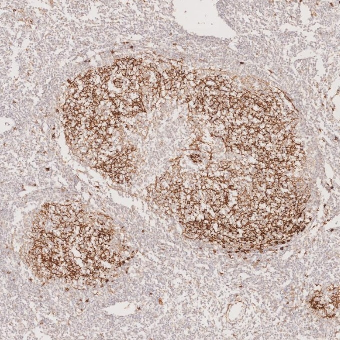 IHC staining of human lymphoma using 60208-2-Ig Immunohistochemistry (IHC) staining of human lymphoma tissue using CD23 Monoclonal antibody (60208-2-Ig)