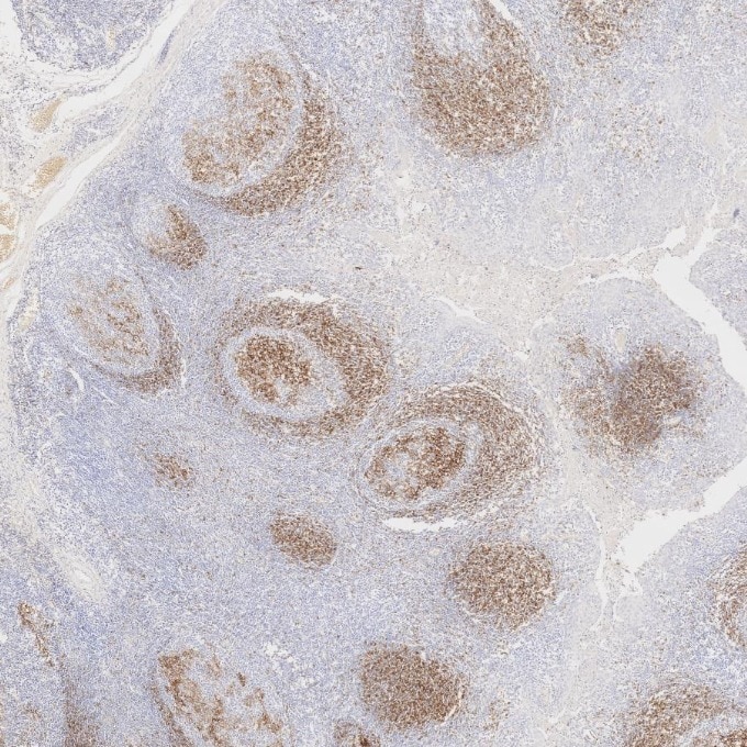 IHC staining of human tonsillitis using 60208-2-Ig Immunohistochemistry (IHC) staining of human tonsillitis tissue using CD23 Monoclonal antibody (60208-2-Ig)