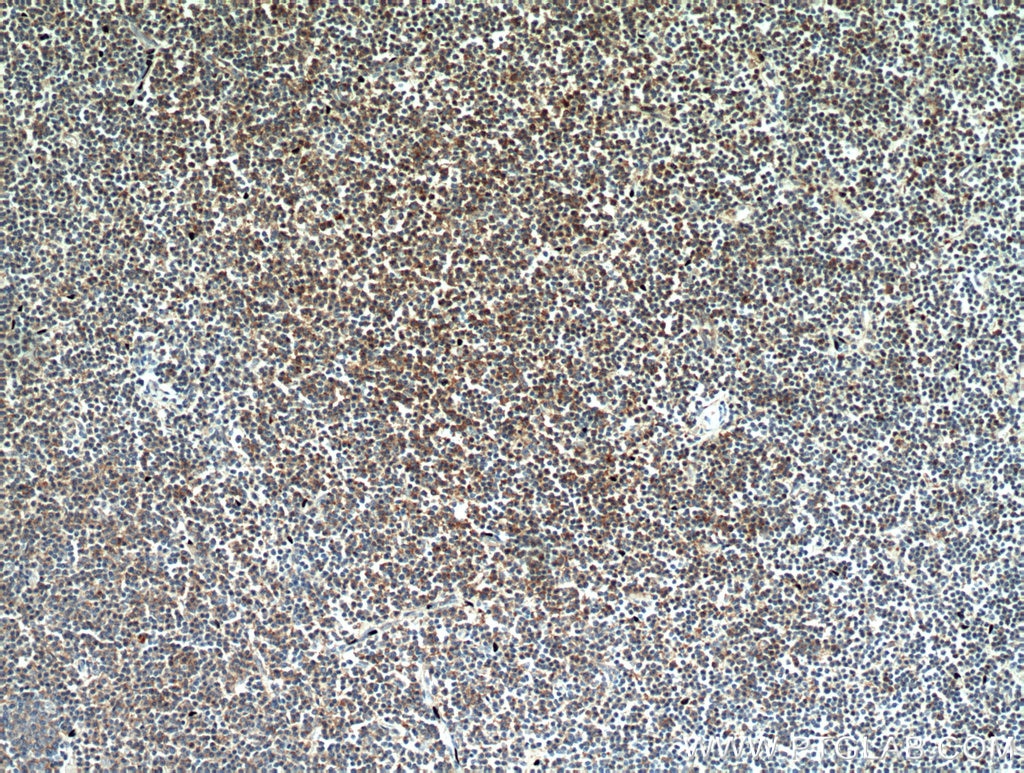 Immunohistochemistry (IHC) staining of human lymphoma tissue using CD23 Monoclonal antibody (60208-2-Ig)