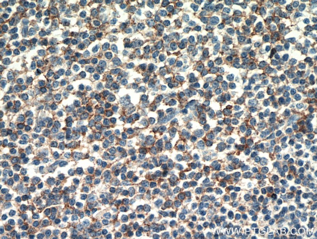 Immunohistochemistry (IHC) staining of human lymphoma tissue using CD23 Monoclonal antibody (60208-2-Ig)