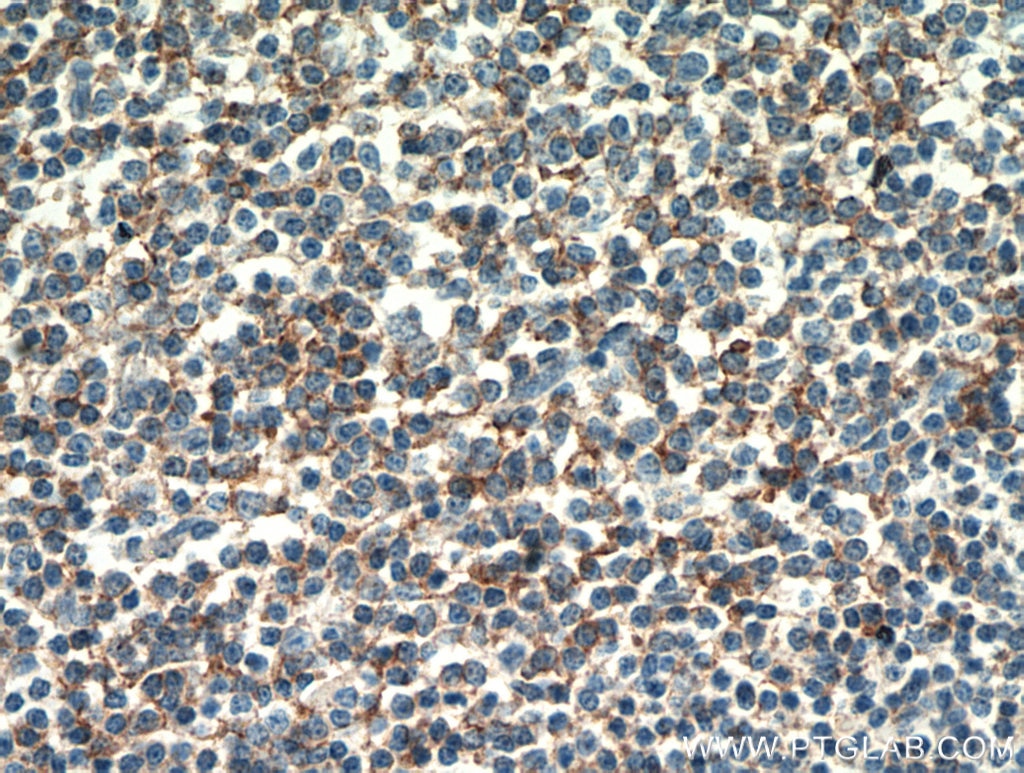 IHC staining of human lymphoma using 60208-2-Ig