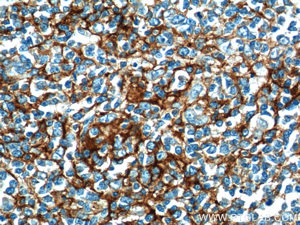 Immunohistochemistry (IHC) staining of human tonsillitis tissue using CD23 Polyclonal antibody (18642-1-AP)