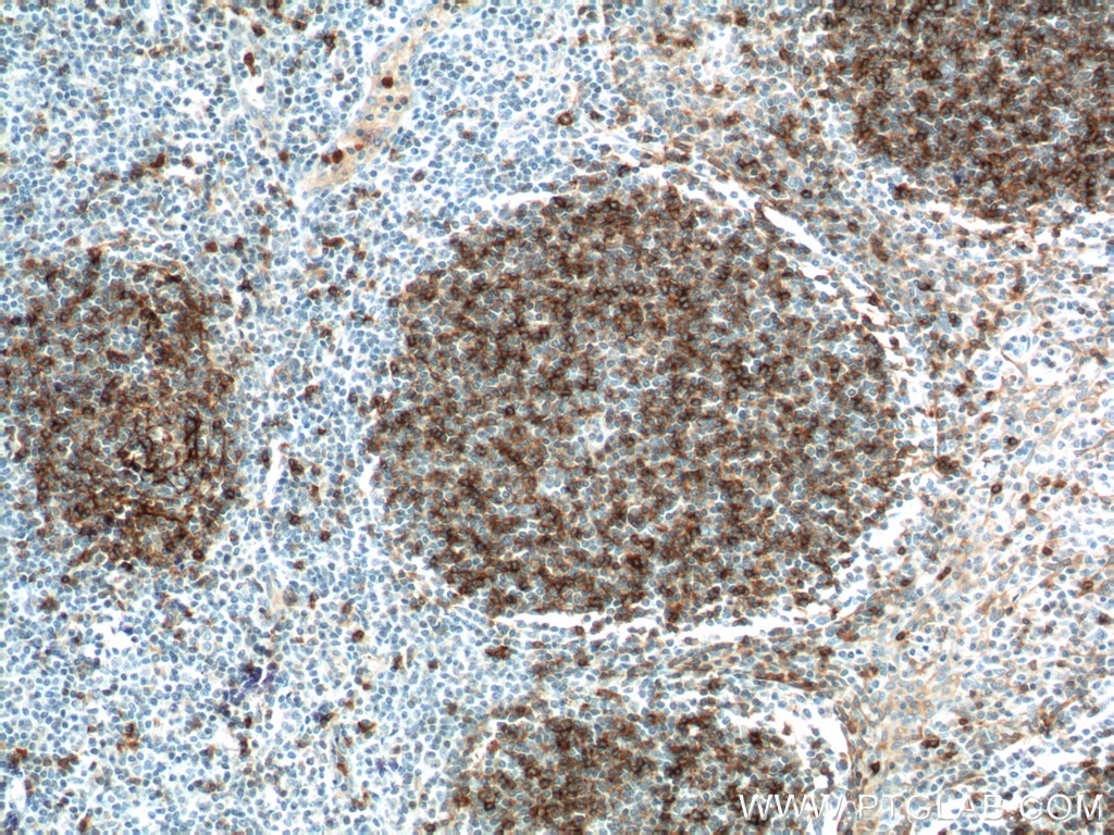 Immunohistochemistry (IHC) staining of human tonsillitis tissue using CD23 Polyclonal antibody (18642-1-AP)