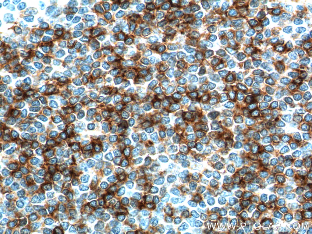 Immunohistochemistry (IHC) staining of human tonsillitis tissue using CD23 Polyclonal antibody (18642-1-AP)