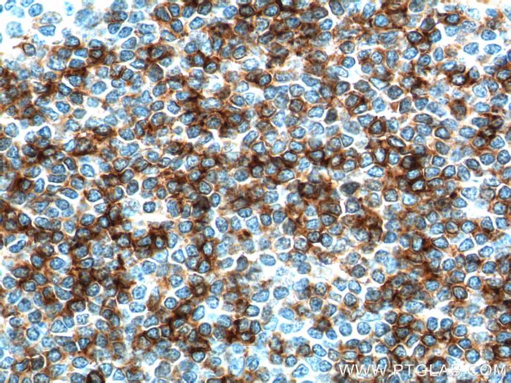 IHC staining of human tonsillitis using 18642-1-AP