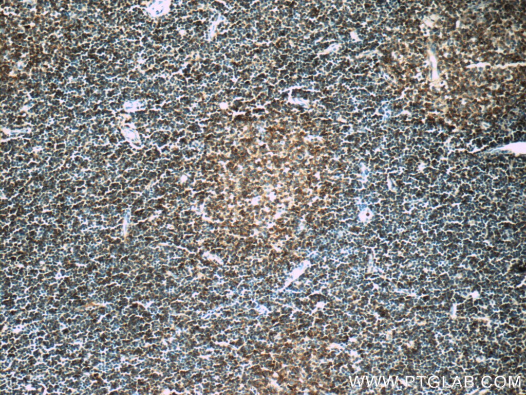 Immunohistochemistry (IHC) staining of human lymphoma tissue using CD23 Polyclonal antibody (18642-1-AP)