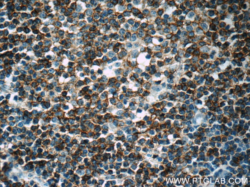 Immunohistochemistry (IHC) staining of human lymphoma tissue using CD23 Polyclonal antibody (18642-1-AP)