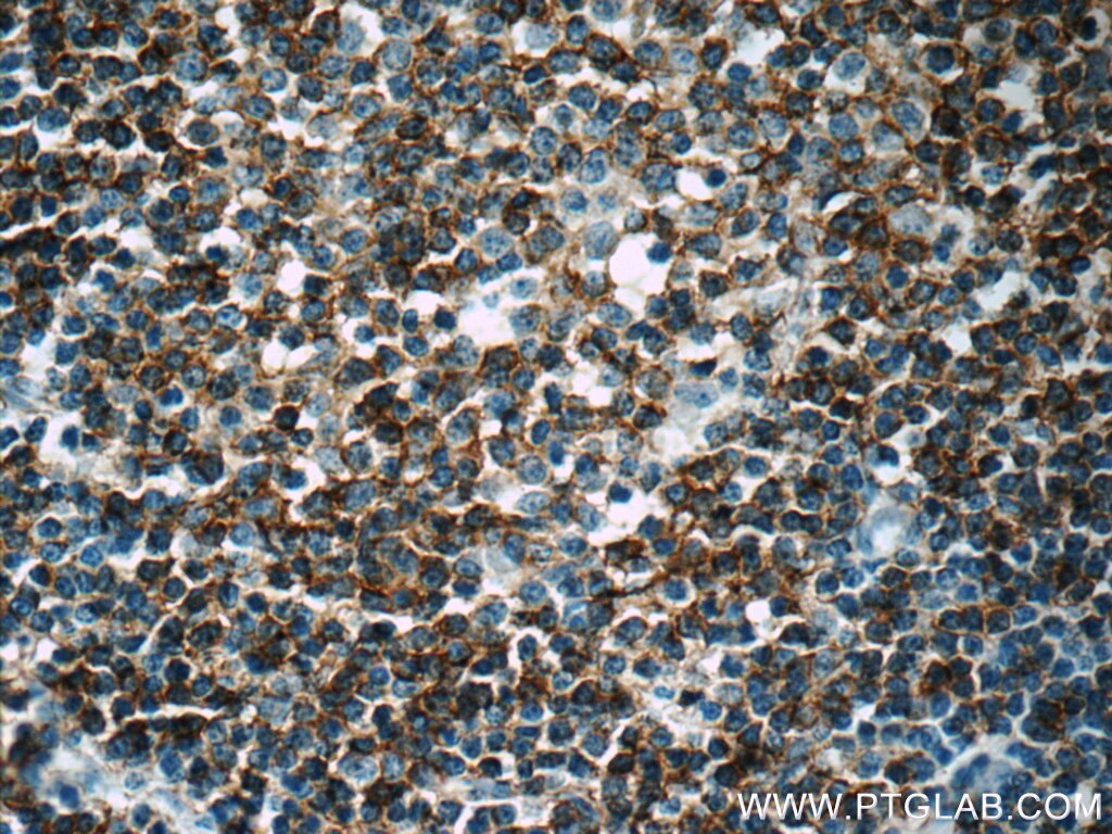 IHC staining of human lymphoma using 18642-1-AP