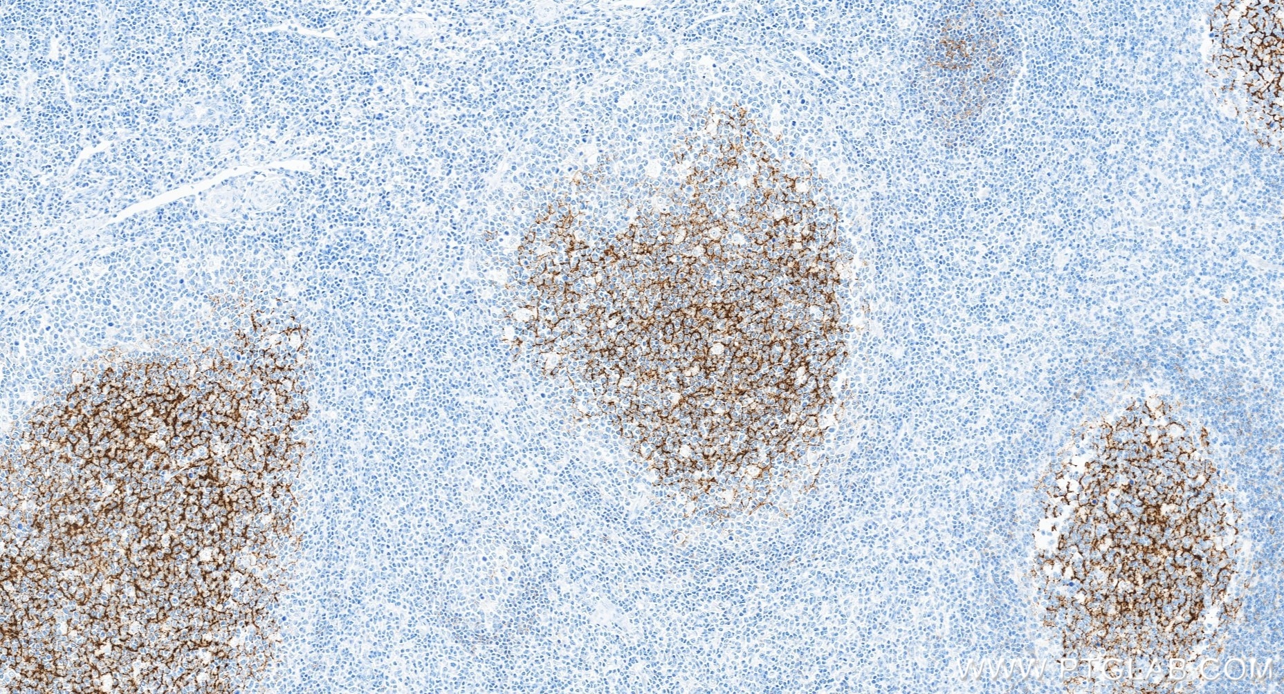 IHC staining of human tonsillitis using 84024-6-RR Immunohistochemistry (IHC) staining of human tonsillitis tissue using CD23 Recombinant monoclonal antibody (84024-6-RR)