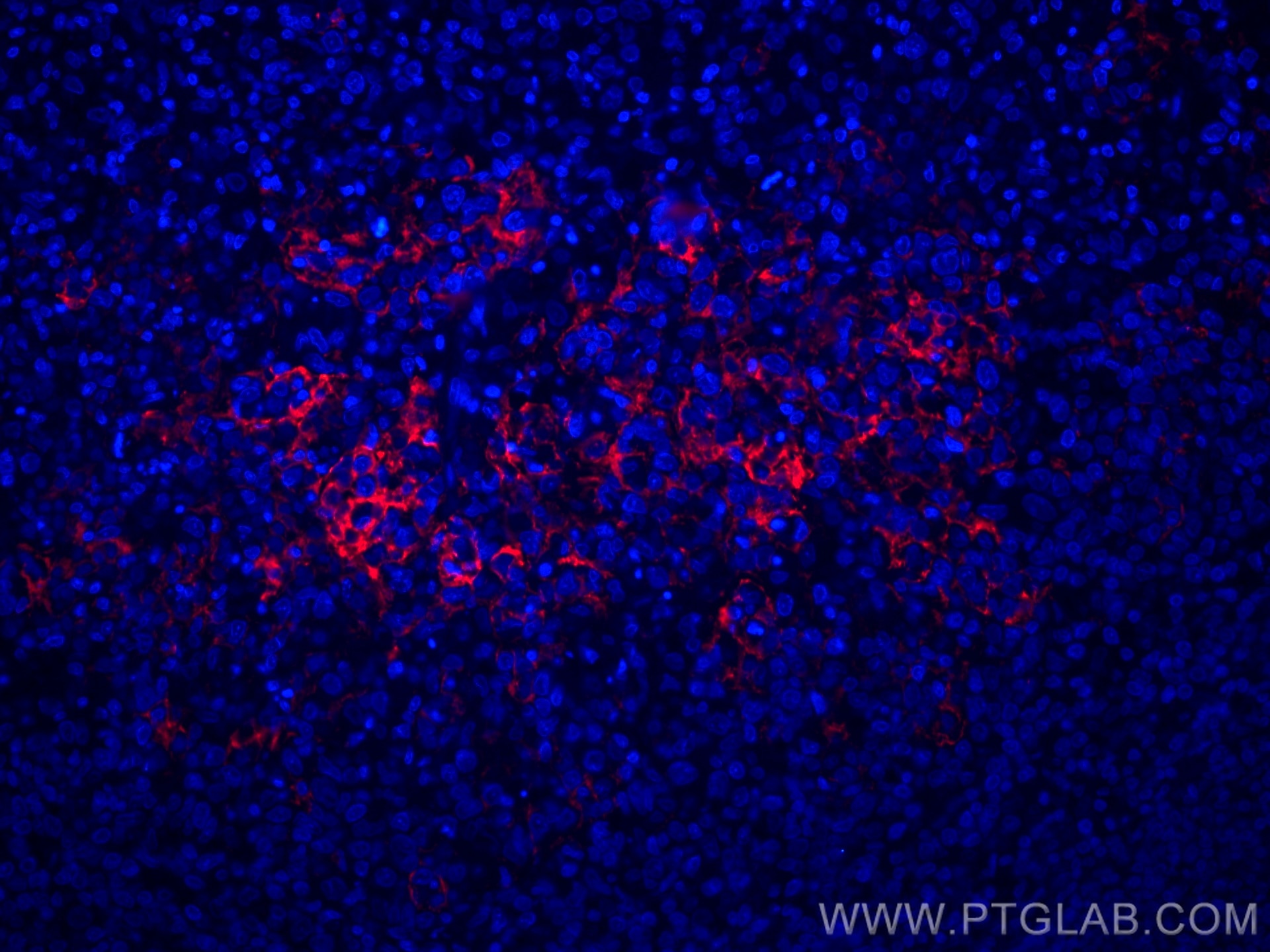 Immunofluorescence (IF) / fluorescent staining of human lymphoma tissue using CoraLite®594-conjugated CD23 Monoclonal antibody (CL594-60208)