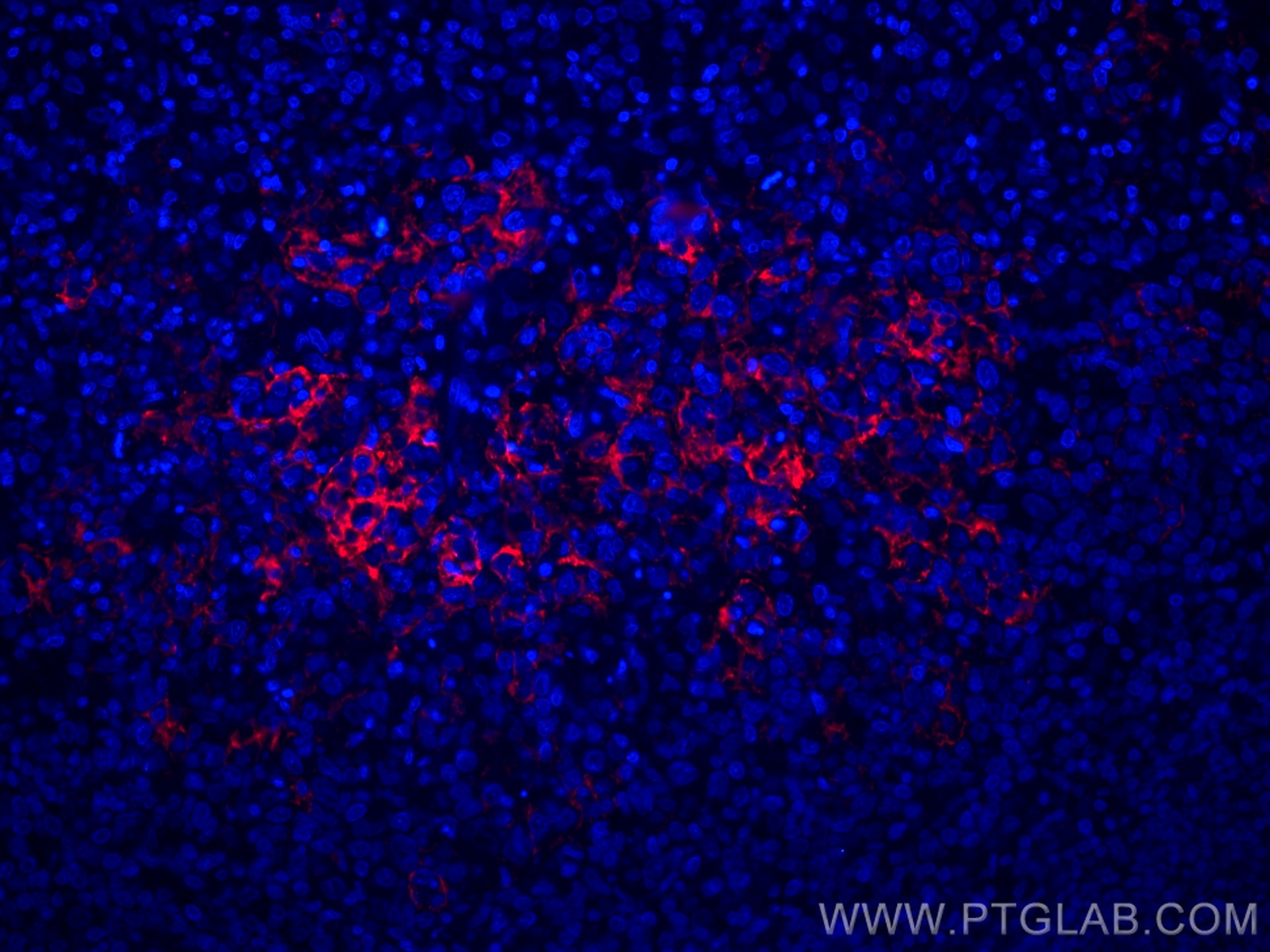 IF Staining of human lymphoma using CL594-60208