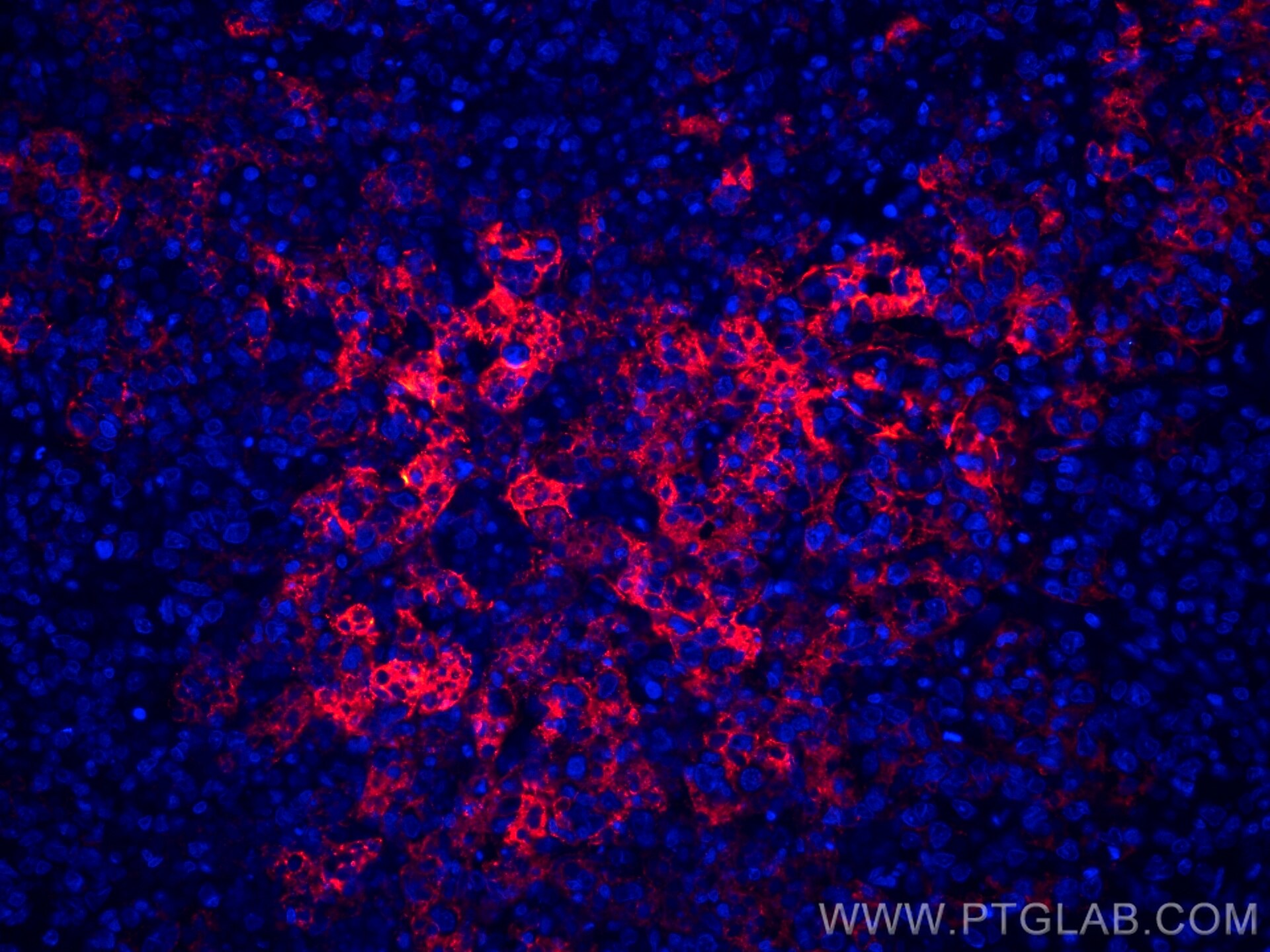 Immunofluorescence (IF) / fluorescent staining of human lymphoma tissue using CoraLite®594-conjugated CD23 Monoclonal antibody (CL594-60208)