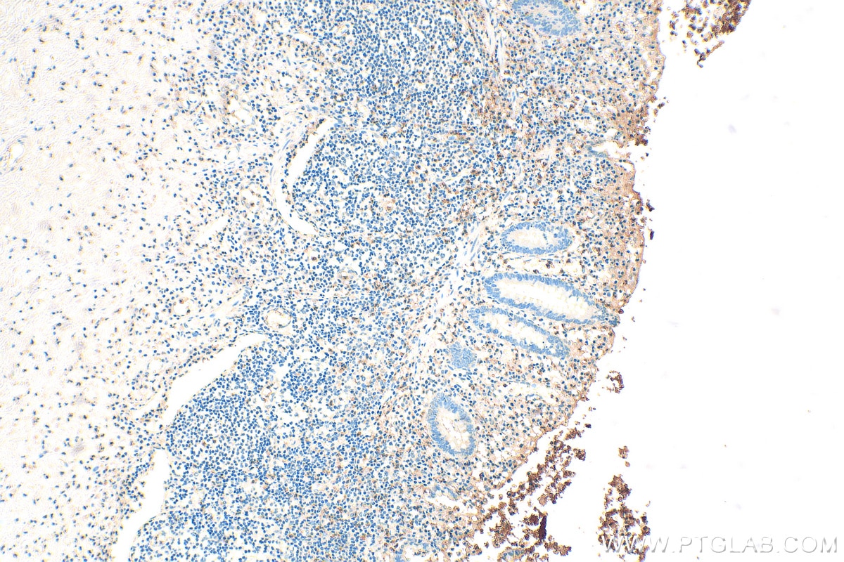 IHC staining of human appendicitis using 10600-1-AP