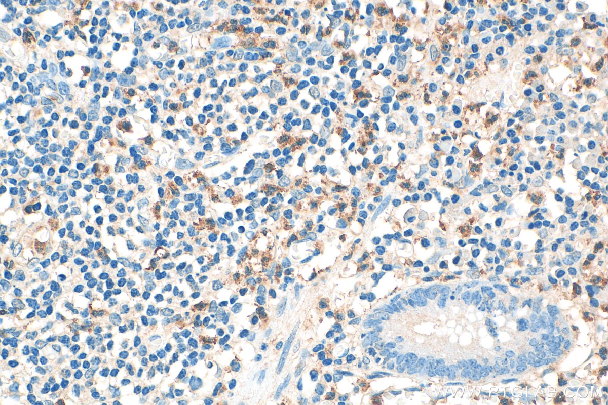 Immunohistochemistry (IHC) staining of human appendicitis tissue using CD24 Polyclonal antibody (10600-1-AP)