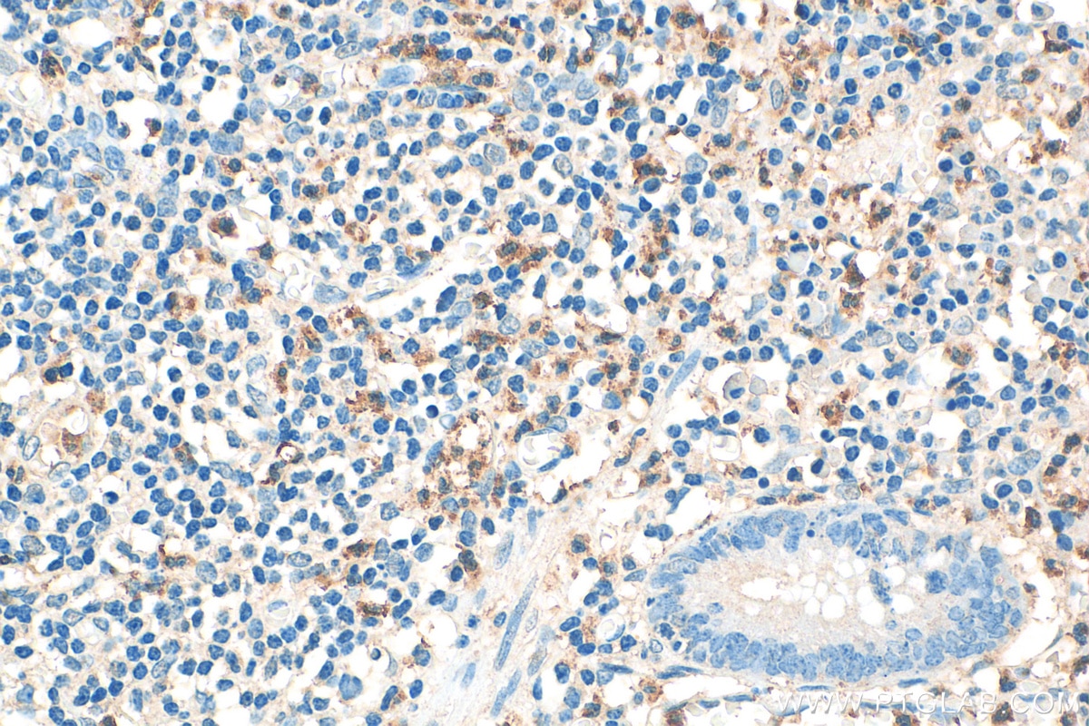 IHC staining of human appendicitis using 10600-1-AP