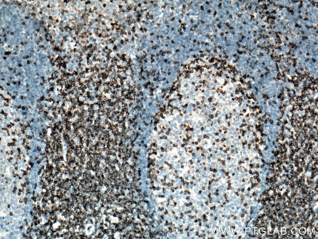 Immunohistochemistry (IHC) staining of human tonsillitis tissue using CD247 Polyclonal antibody (12837-2-AP)