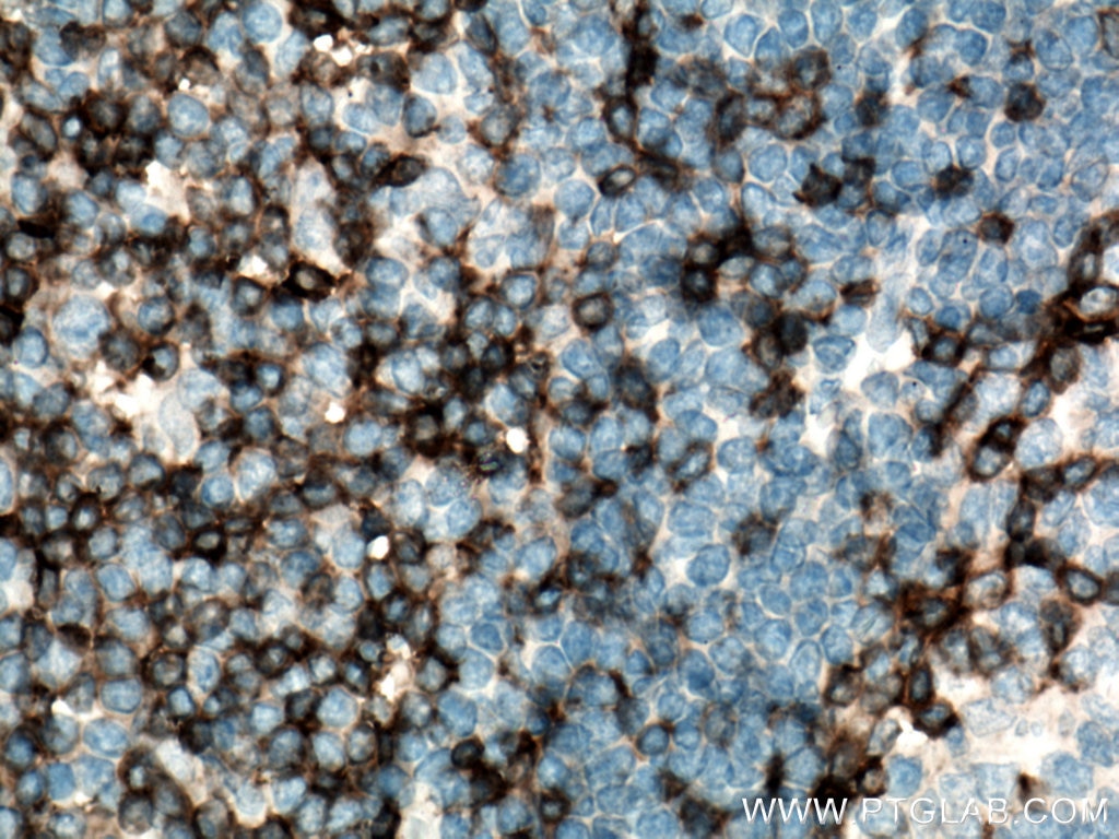 Immunohistochemistry (IHC) staining of human tonsillitis tissue using CD247 Polyclonal antibody (12837-2-AP)