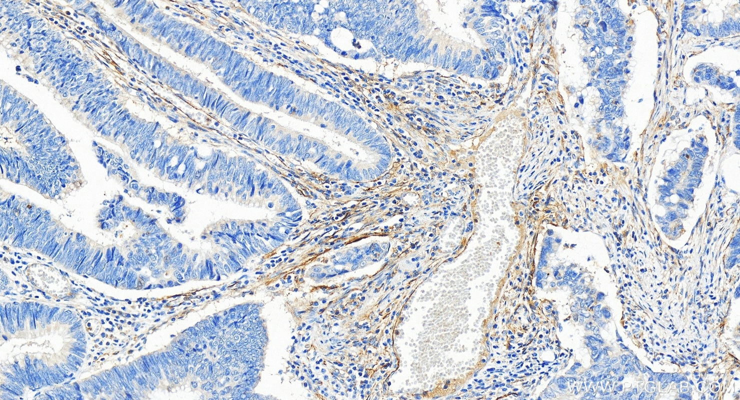 Immunohistochemistry (IHC) staining of human colon cancer tissue using TEM1 Polyclonal antibody (18160-1-AP)