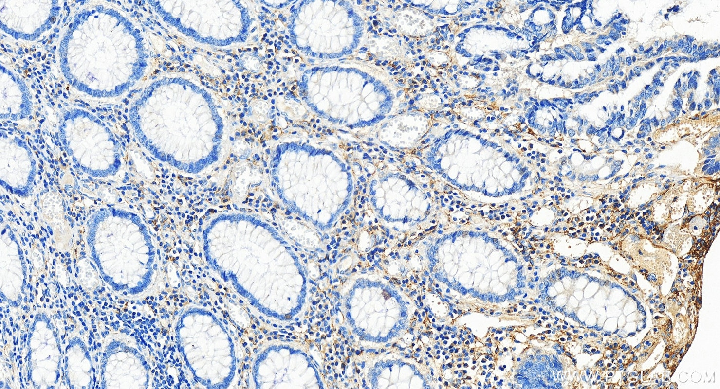 Immunohistochemistry (IHC) staining of human colon cancer tissue using TEM1 Polyclonal antibody (18160-1-AP)