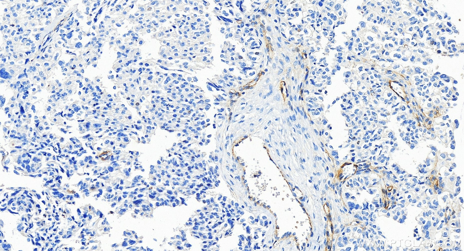 Immunohistochemistry (IHC) staining of human ovary cancer tissue using TEM1 Polyclonal antibody (18160-1-AP)