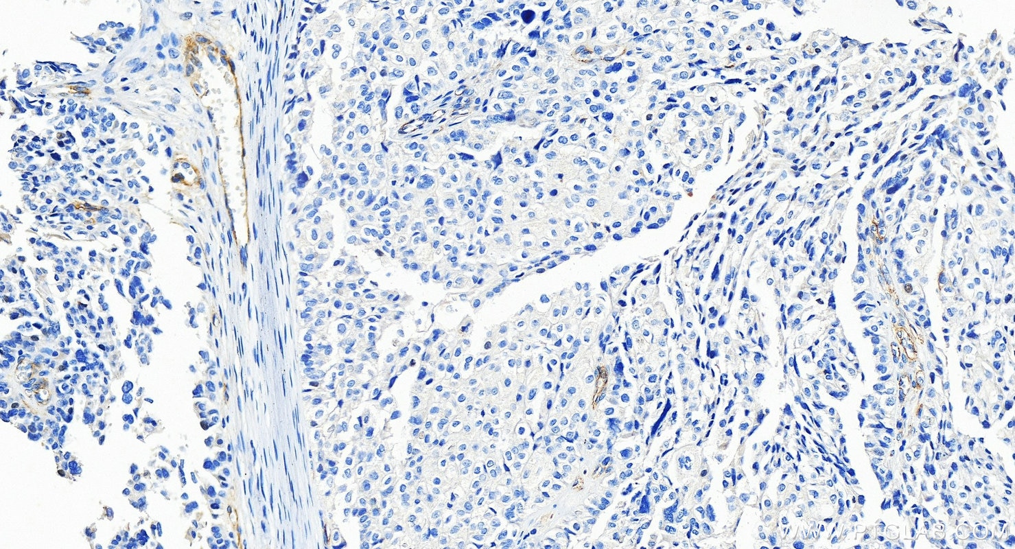 Immunohistochemistry (IHC) staining of human ovary cancer tissue using TEM1 Polyclonal antibody (18160-1-AP)