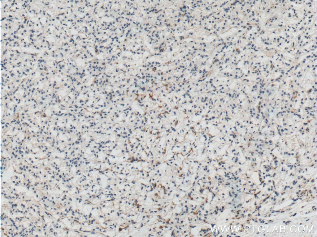 Immunohistochemistry (IHC) staining of human renal cell carcinoma tissue using TEM1 Monoclonal antibody (60170-1-Ig)